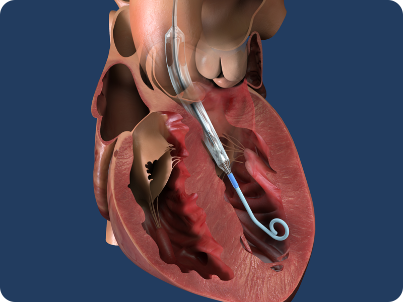 Dispositivo  de asistencia ventricular Impella.
