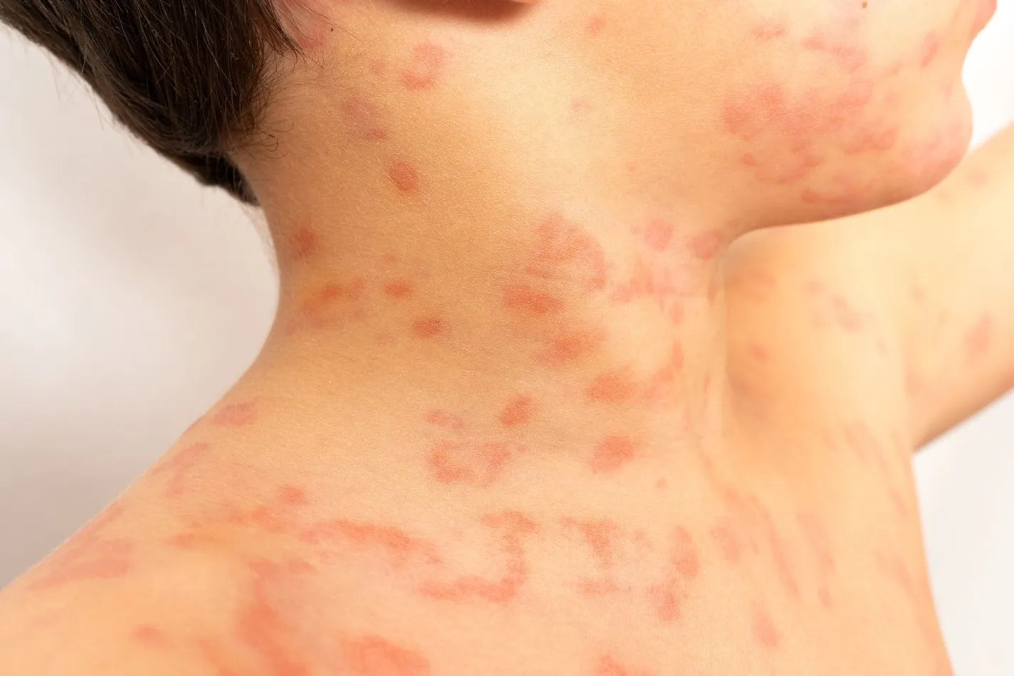 Erupciones en la piel infantil y cómo reconocerlas