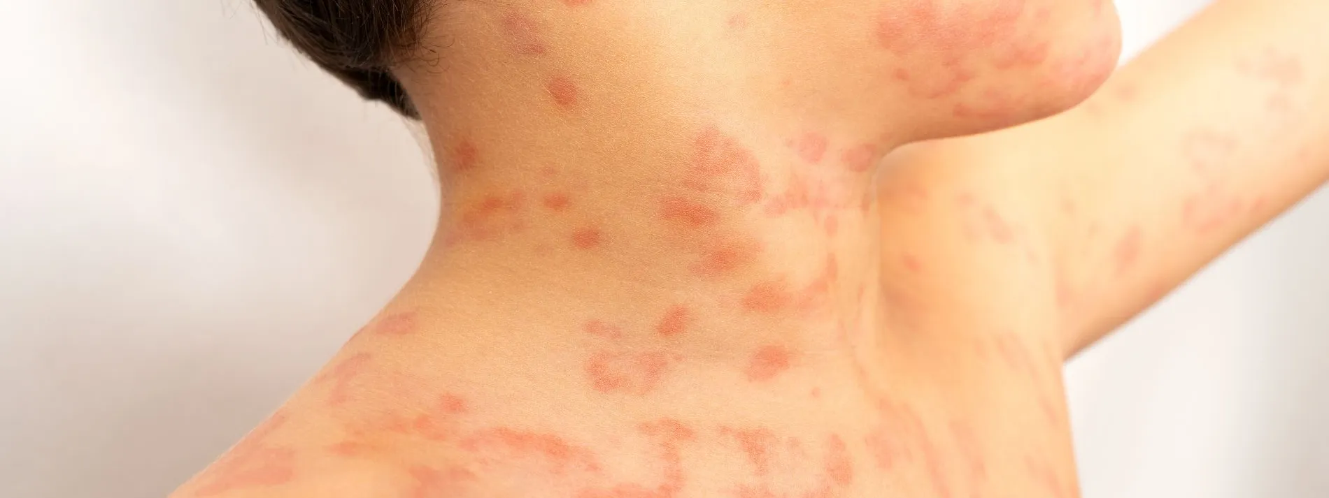 Erupciones en la piel infantil y cómo reconocerlas